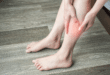 Симптоми на тромб в крака: Кога спешно да се обадите на лекар